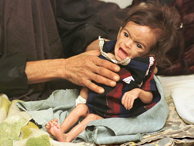 Child victim of malnutrition in Iraq