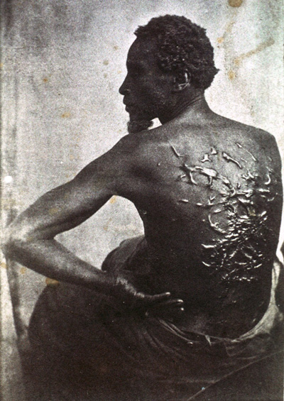 Gordon, who escaped from Louisiana slavery, 1863.  Photo: AP